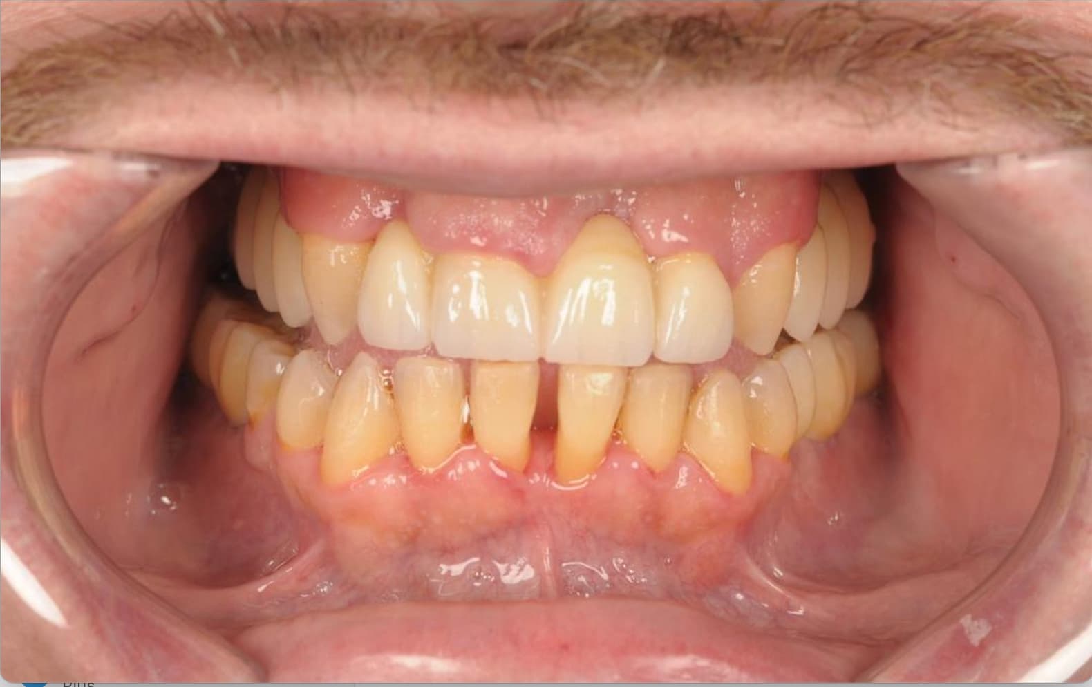 Full mouth rehabilitation — front view — after treatment