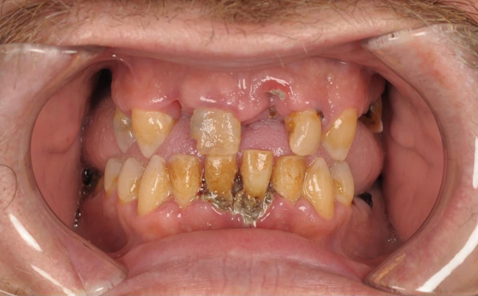 Full mouth rehabilitation — front view — before treatment