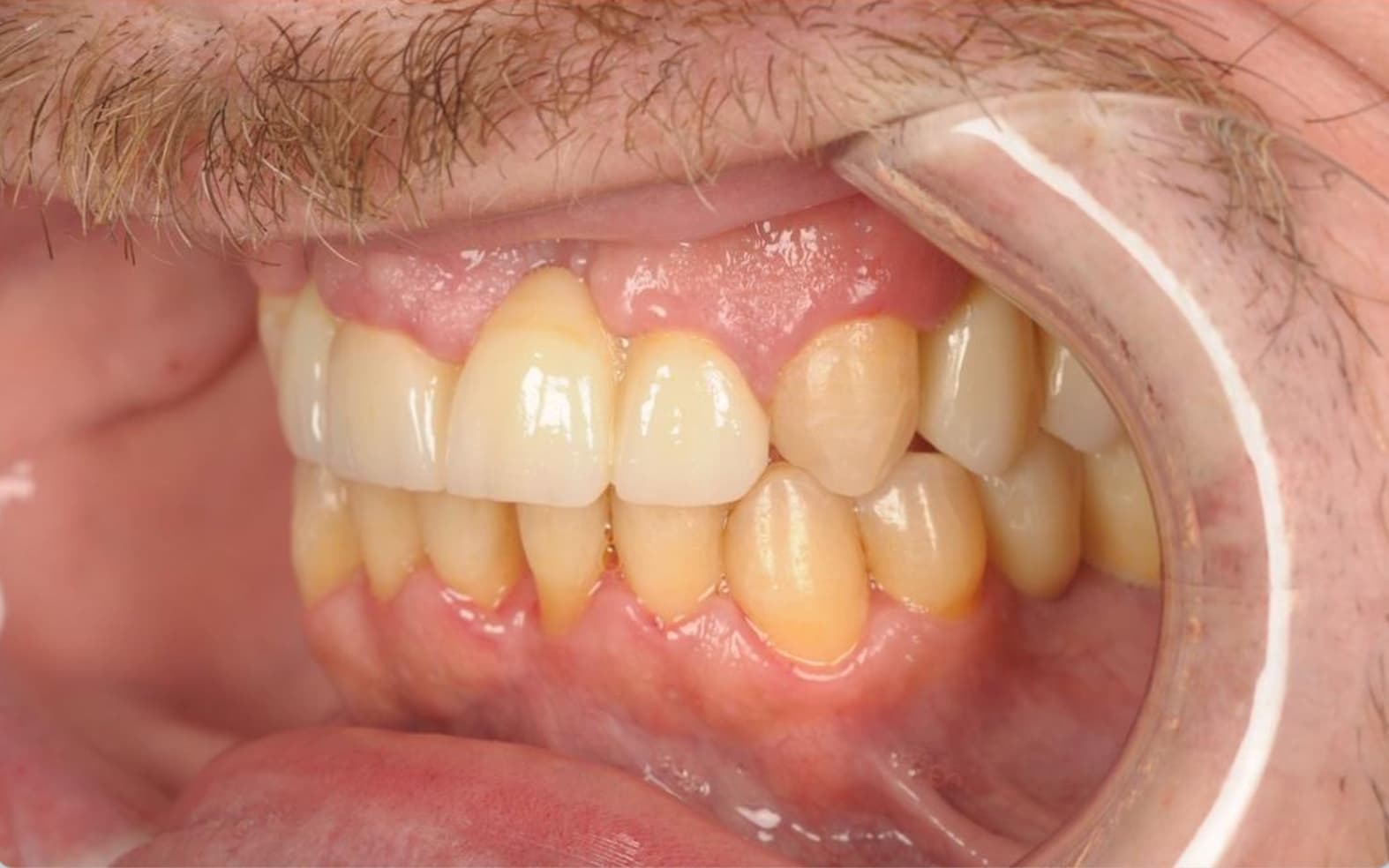 Full mouth rehabilitation — improved bite and profile — after treatment