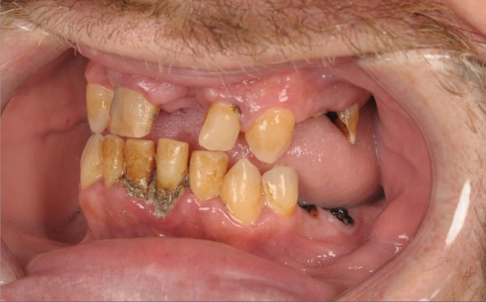 Full mouth rehabilitation — improved bite and profile — before treatment