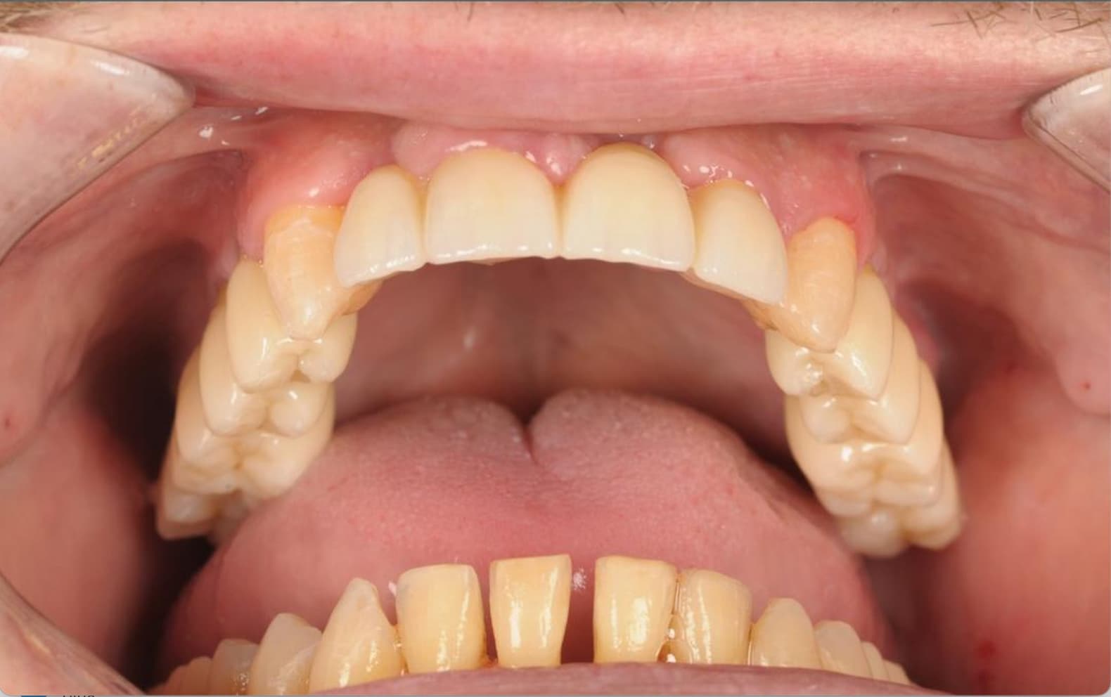 Full upper arch rehabilitation with fixed prosthesis — after treatment
