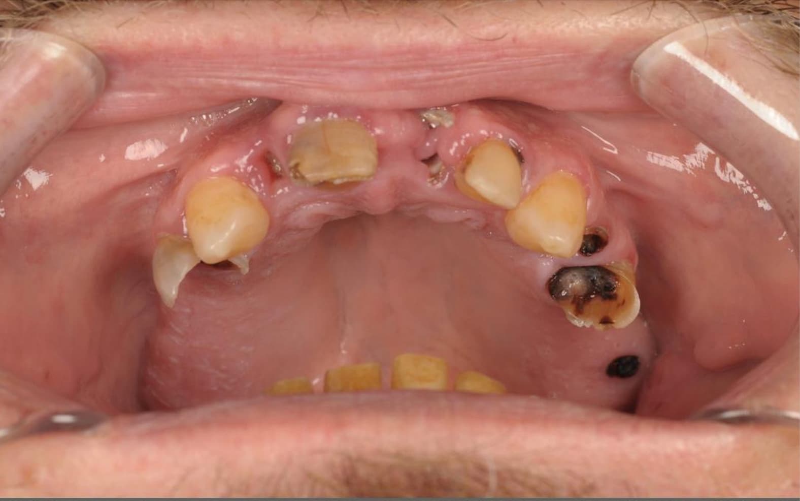 Full upper arch rehabilitation with fixed prosthesis — before treatment