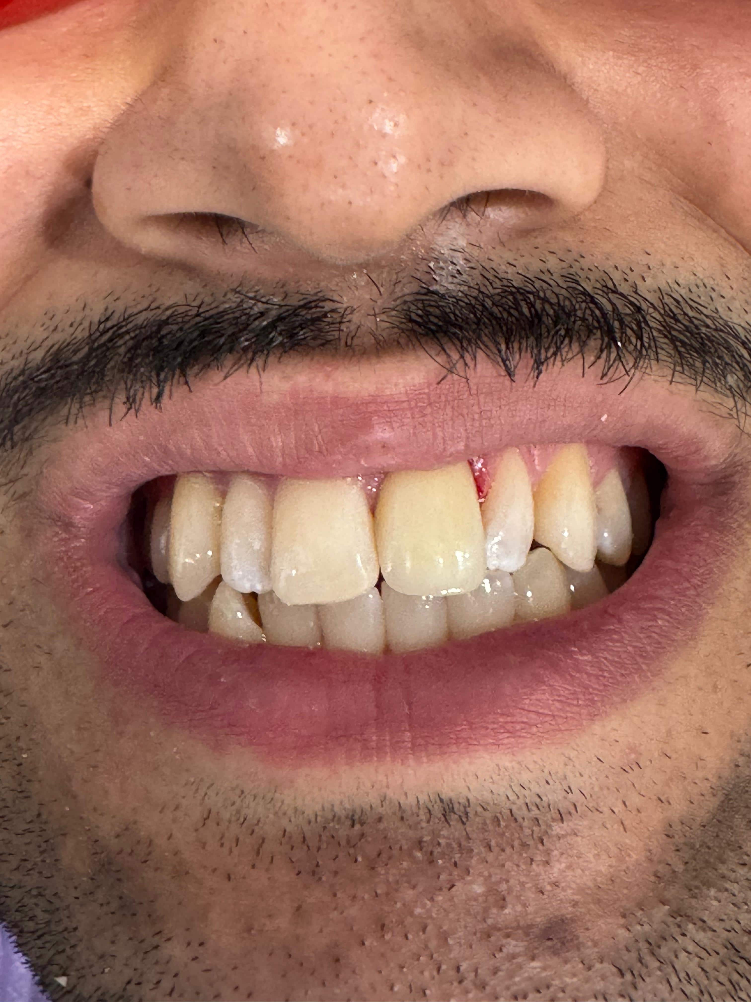 Emergency root canal and crown for a fractured front tooth — after treatment