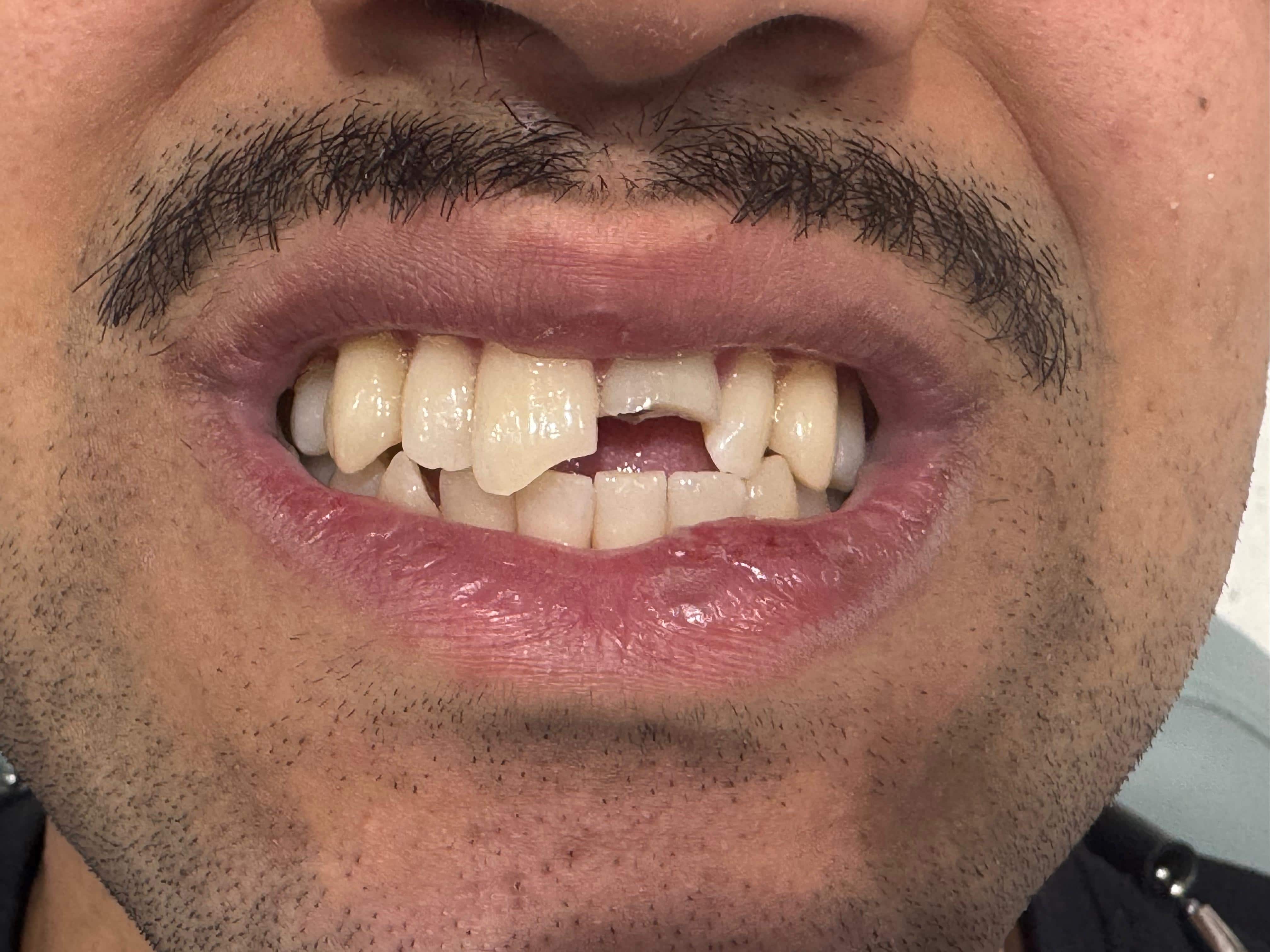 Emergency root canal and crown for a fractured front tooth — before treatment