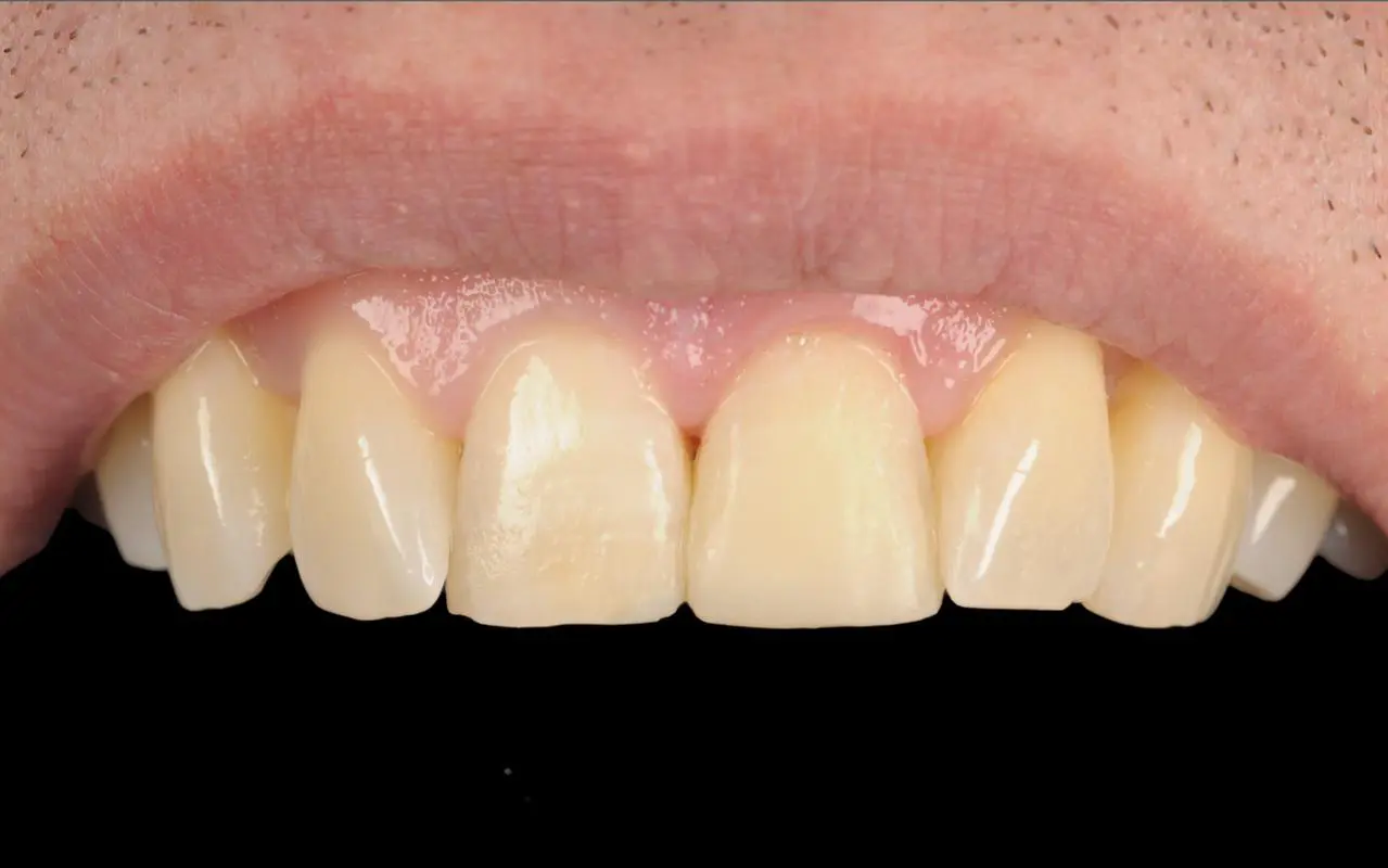 Dental composite restoration — after treatment