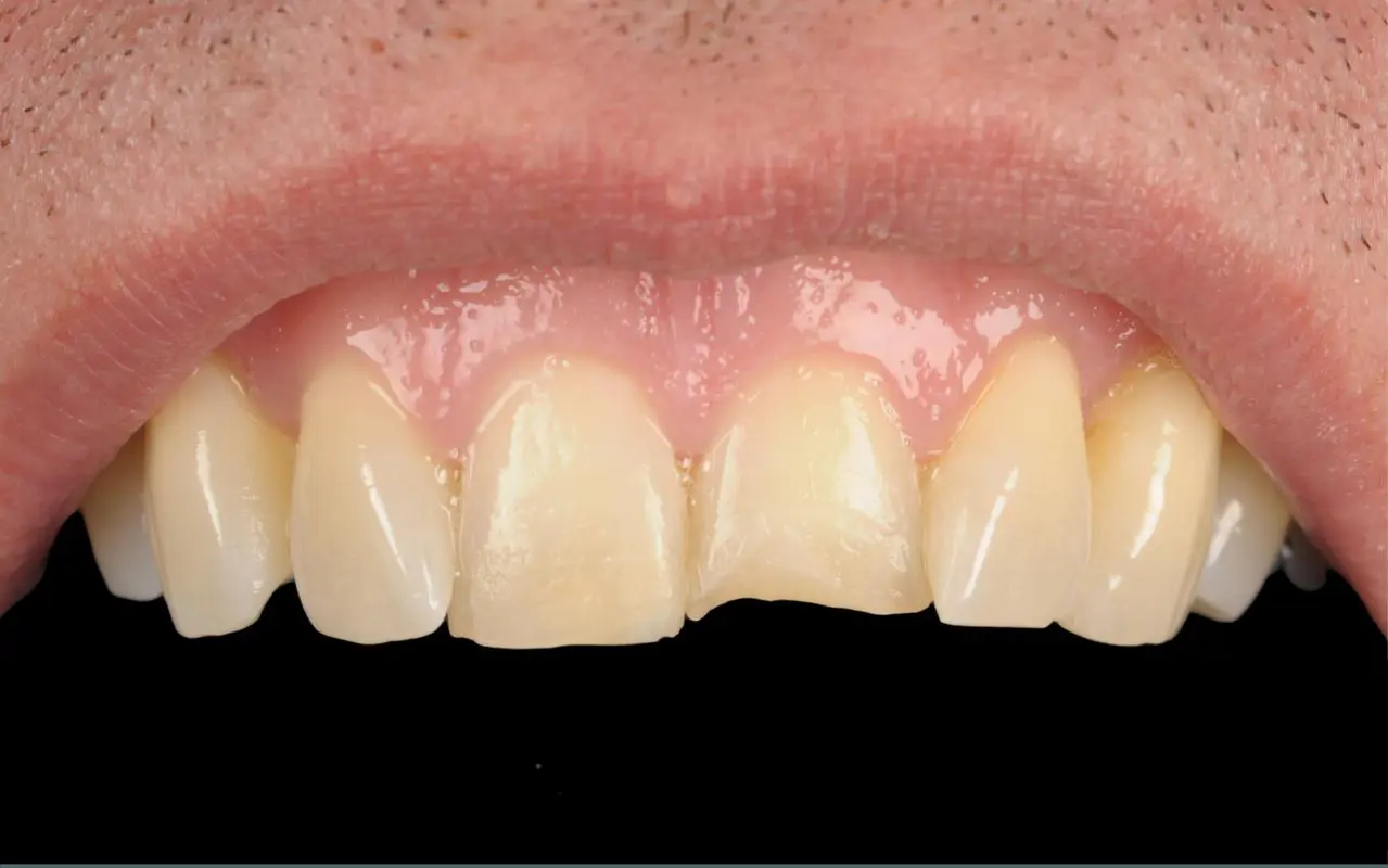 Dental composite restoration — before treatment