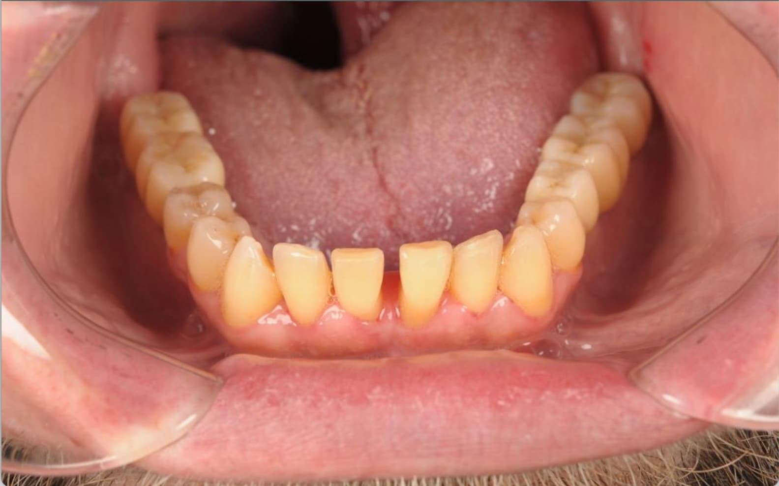 Full arch prosthetic restoration — after treatment