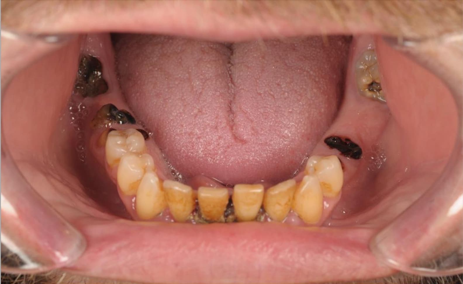 Full arch prosthetic restoration — before treatment