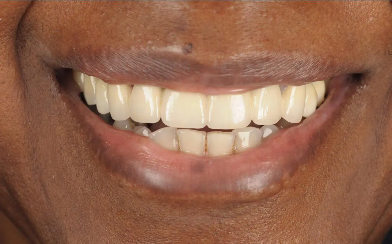 Dental implant restoration — after treatment