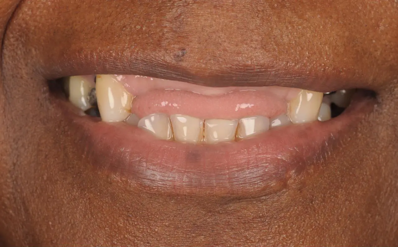 Dental implant restoration — before treatment