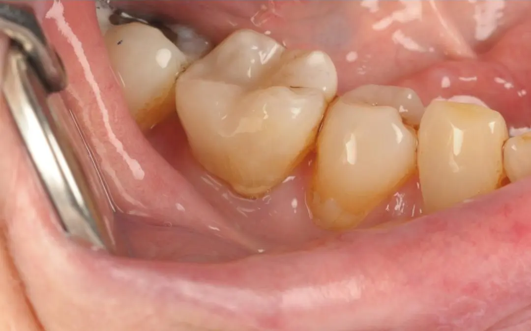Natural-looking white composite fillings — after treatment