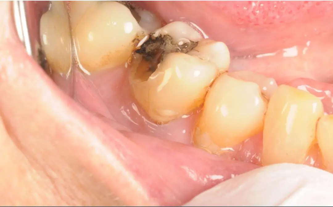 Natural-looking white composite fillings — before treatment