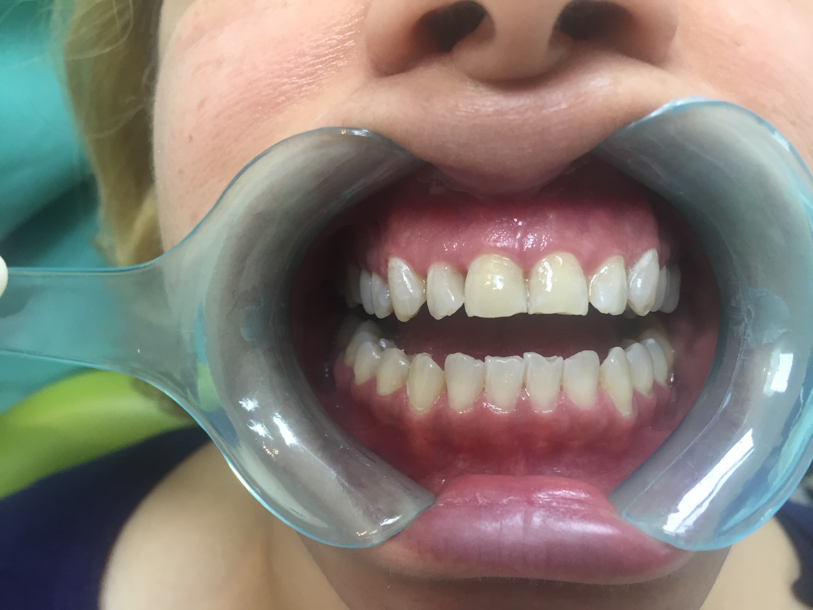 Discoloured and chipped front teeth transformation — after treatment