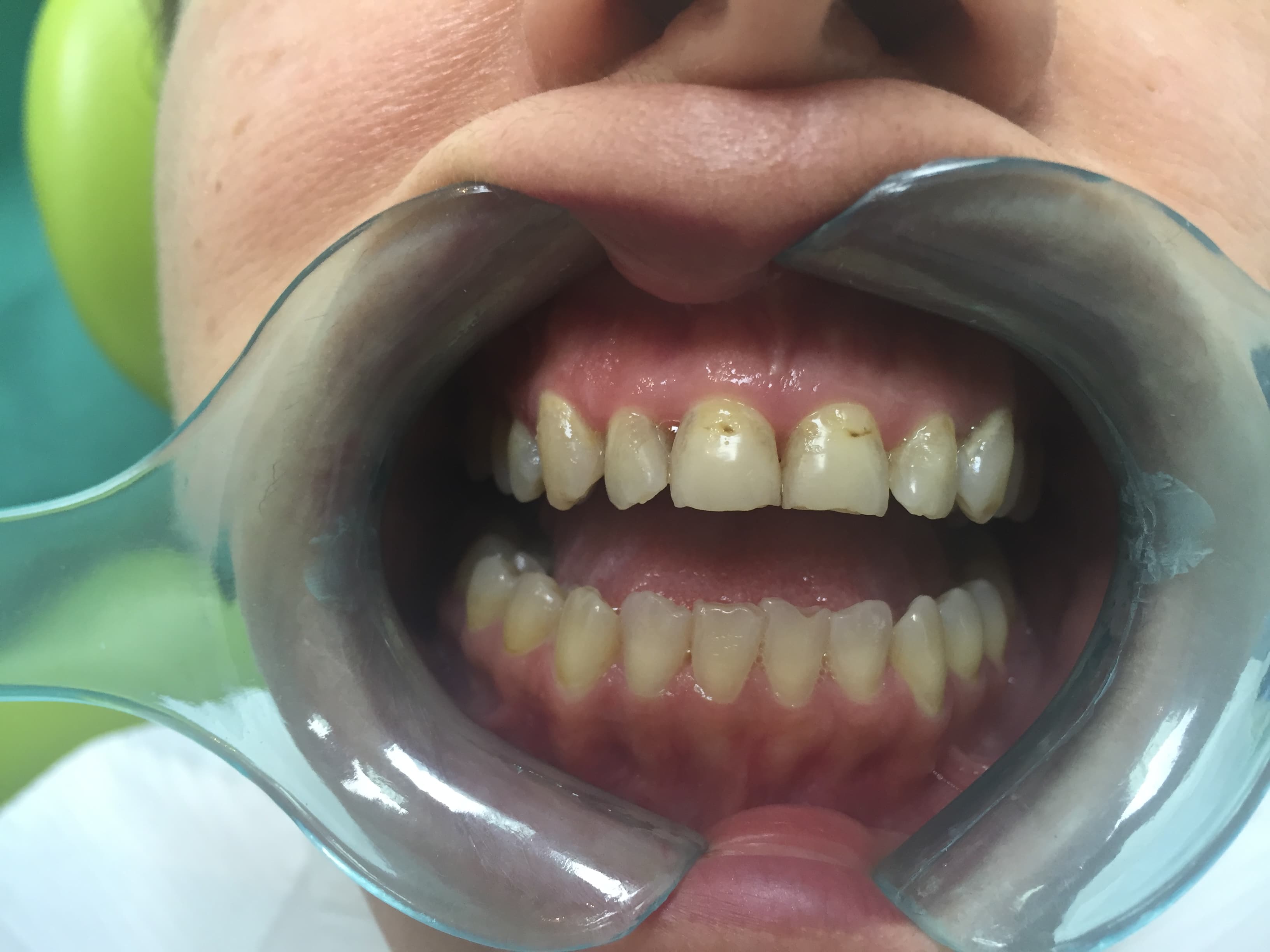 Discoloured and chipped front teeth transformation — before treatment