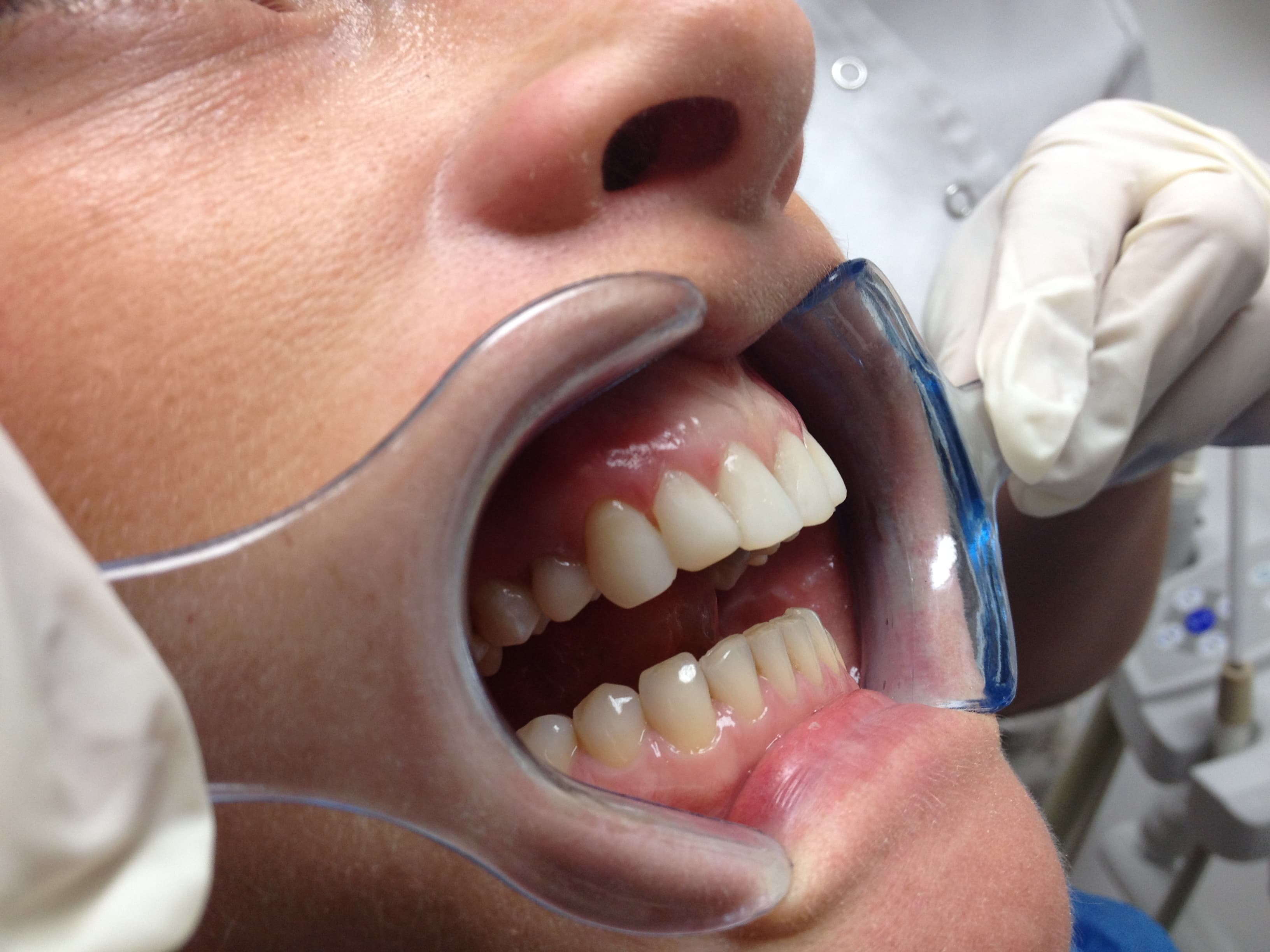 Composite bonding refinement — after treatment