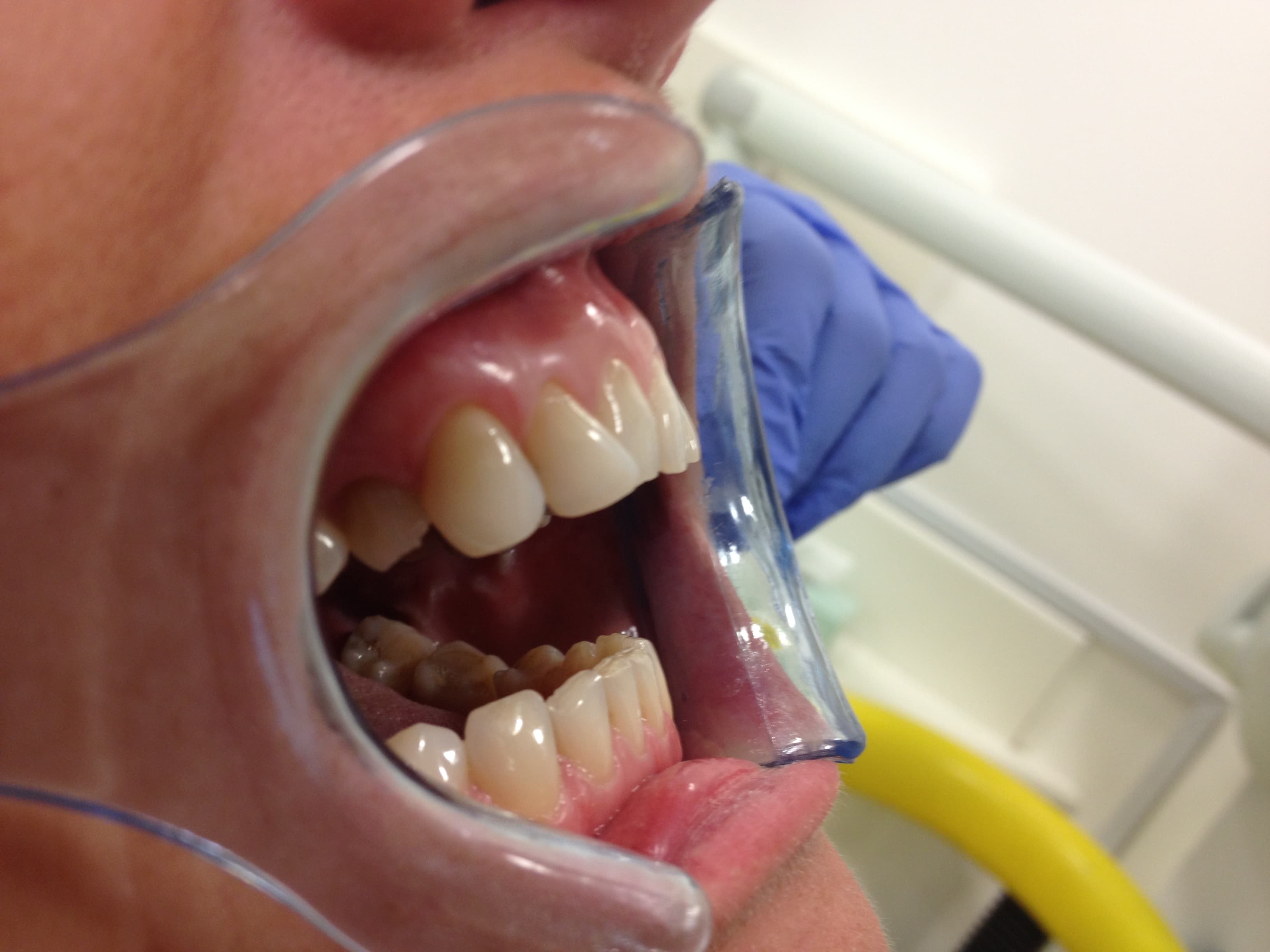 Composite bonding refinement — before treatment