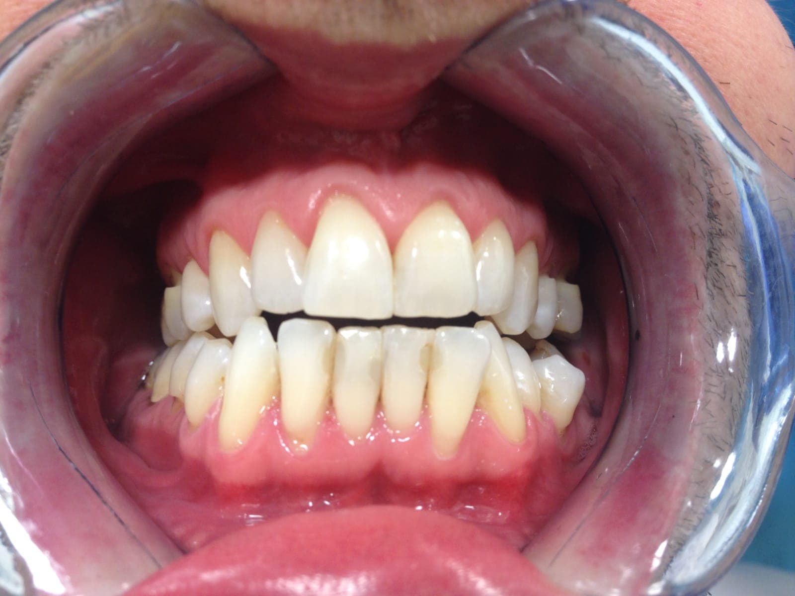 Professional home whitening — after treatment