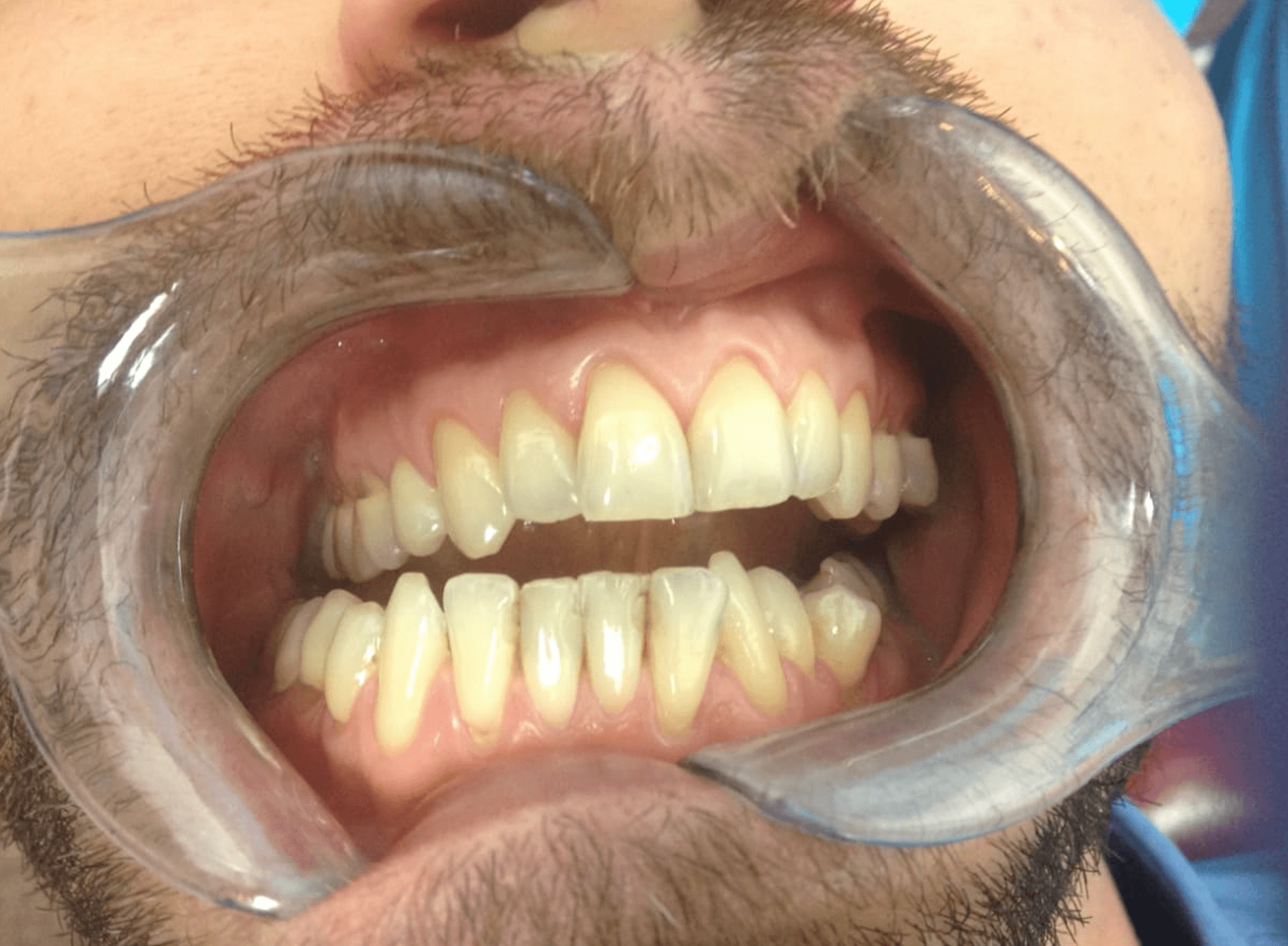 Professional home whitening — before treatment