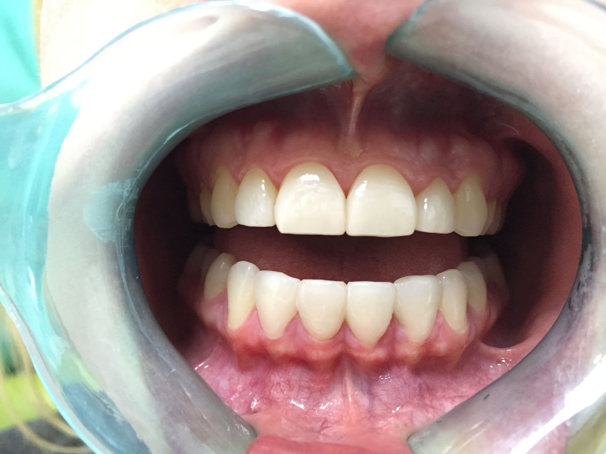 Full smile transformation with 20 porcelain veneers — after treatment