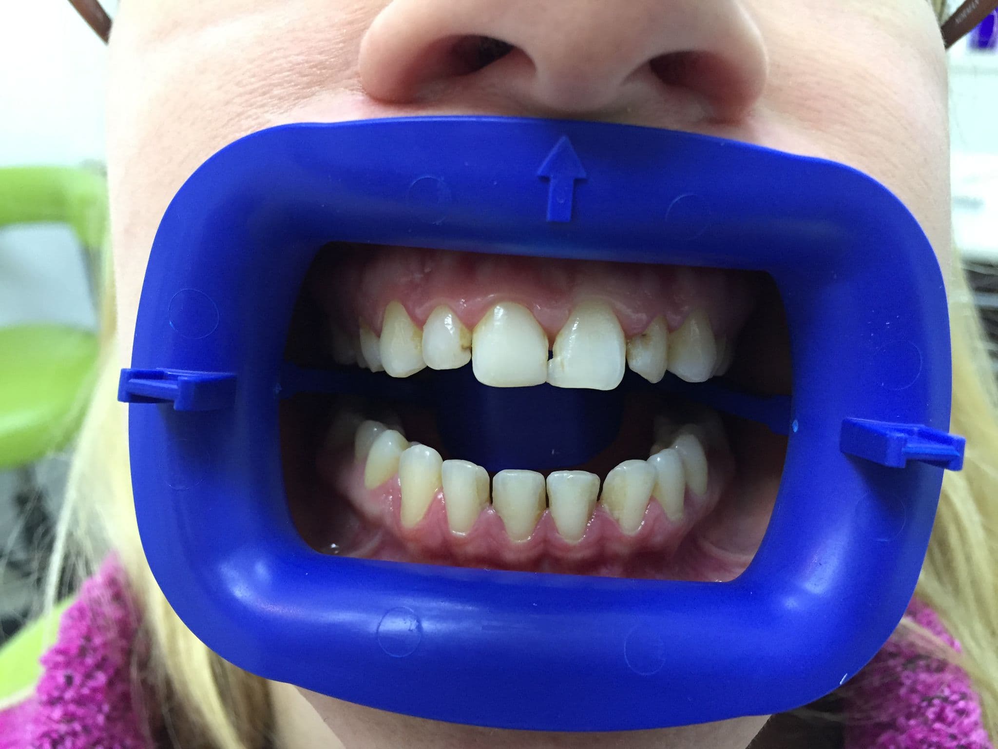 Full smile transformation with 20 porcelain veneers — before treatment