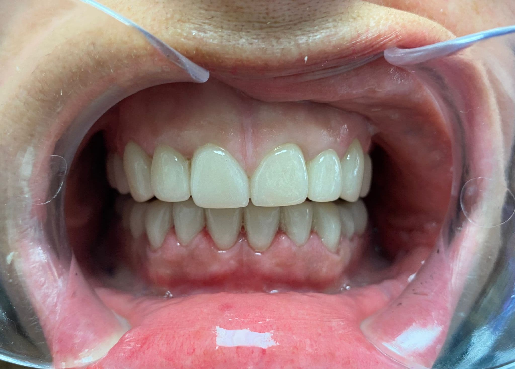 Full smile rejuvenation with 24 veneers and crowns — after treatment