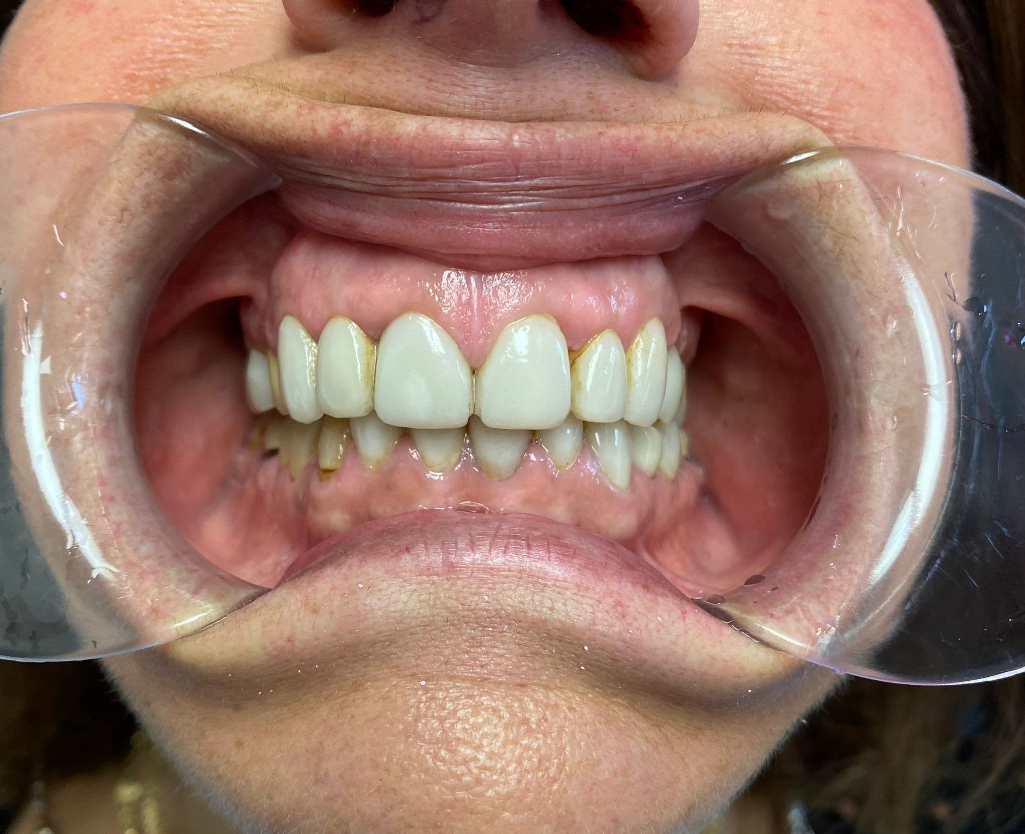 Full smile rejuvenation with 24 veneers and crowns — before treatment
