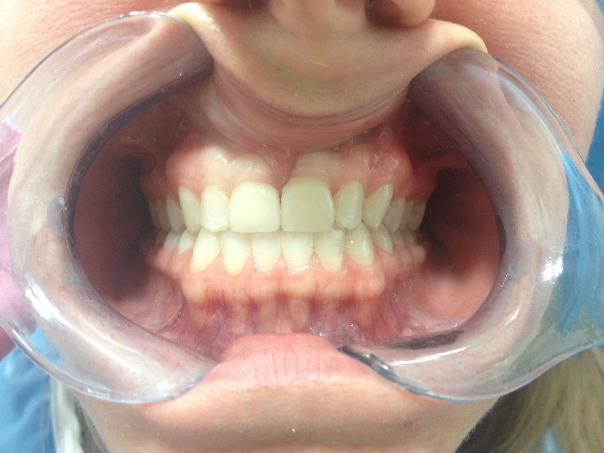 Long-lasting porcelain veneers — 11-year follow-up — after treatment