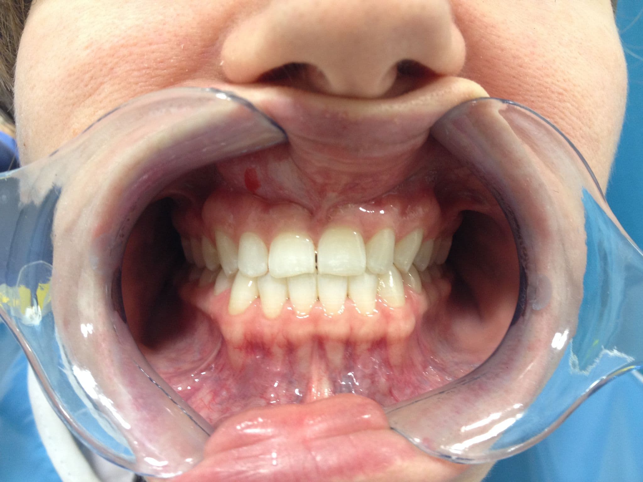Long-lasting porcelain veneers — 11-year follow-up — before treatment