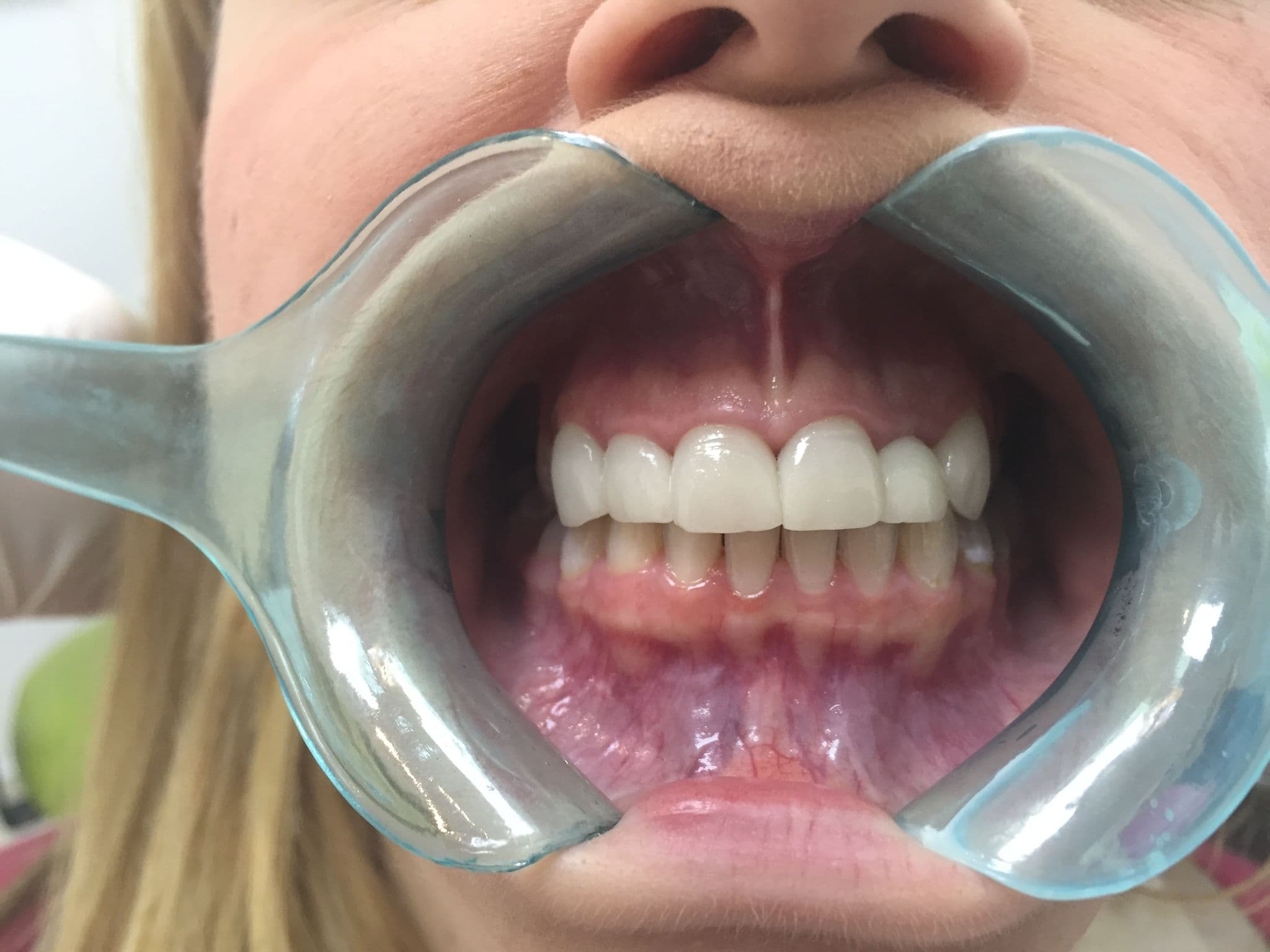 Smile makeover with whitening and six veneers — after treatment