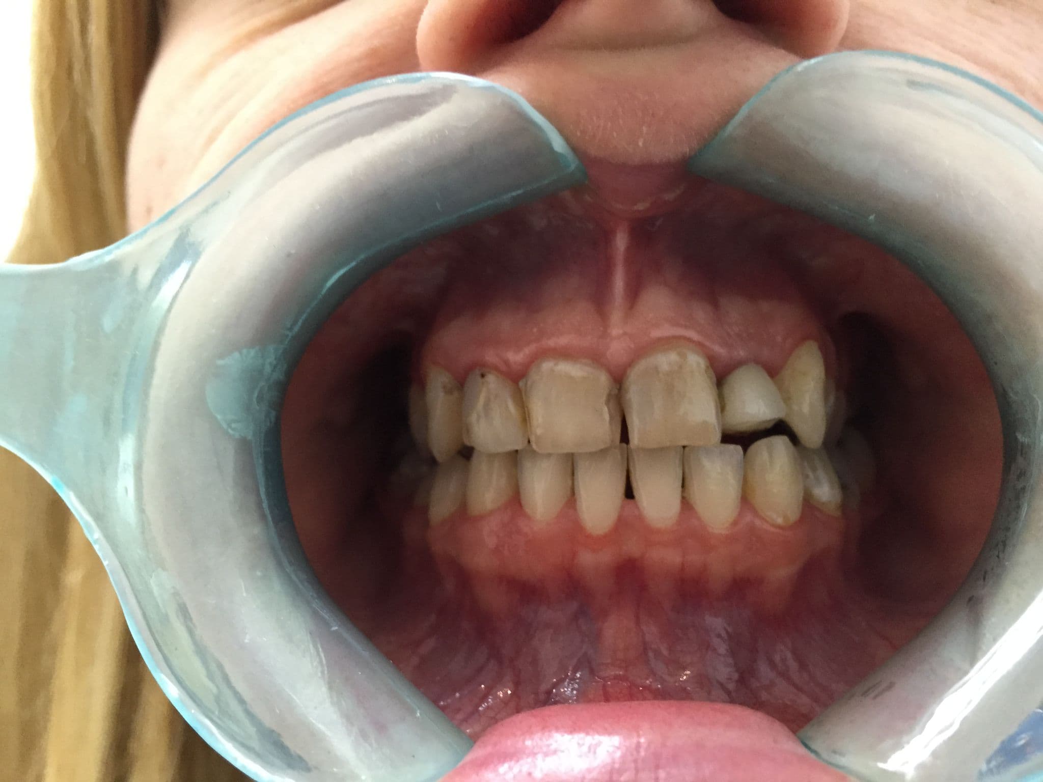 Smile makeover with whitening and six veneers — before treatment