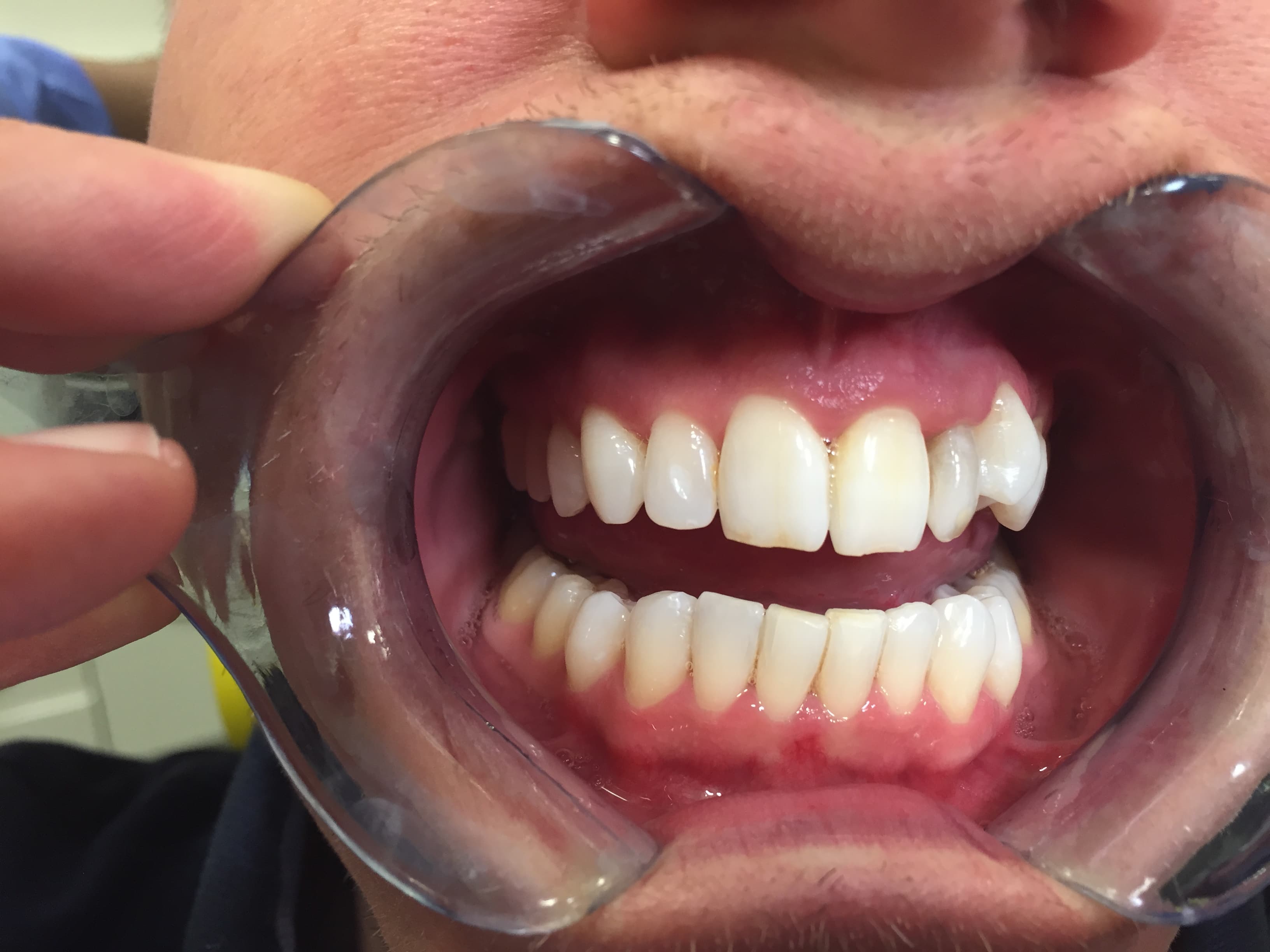 Professional teeth whitening — after treatment