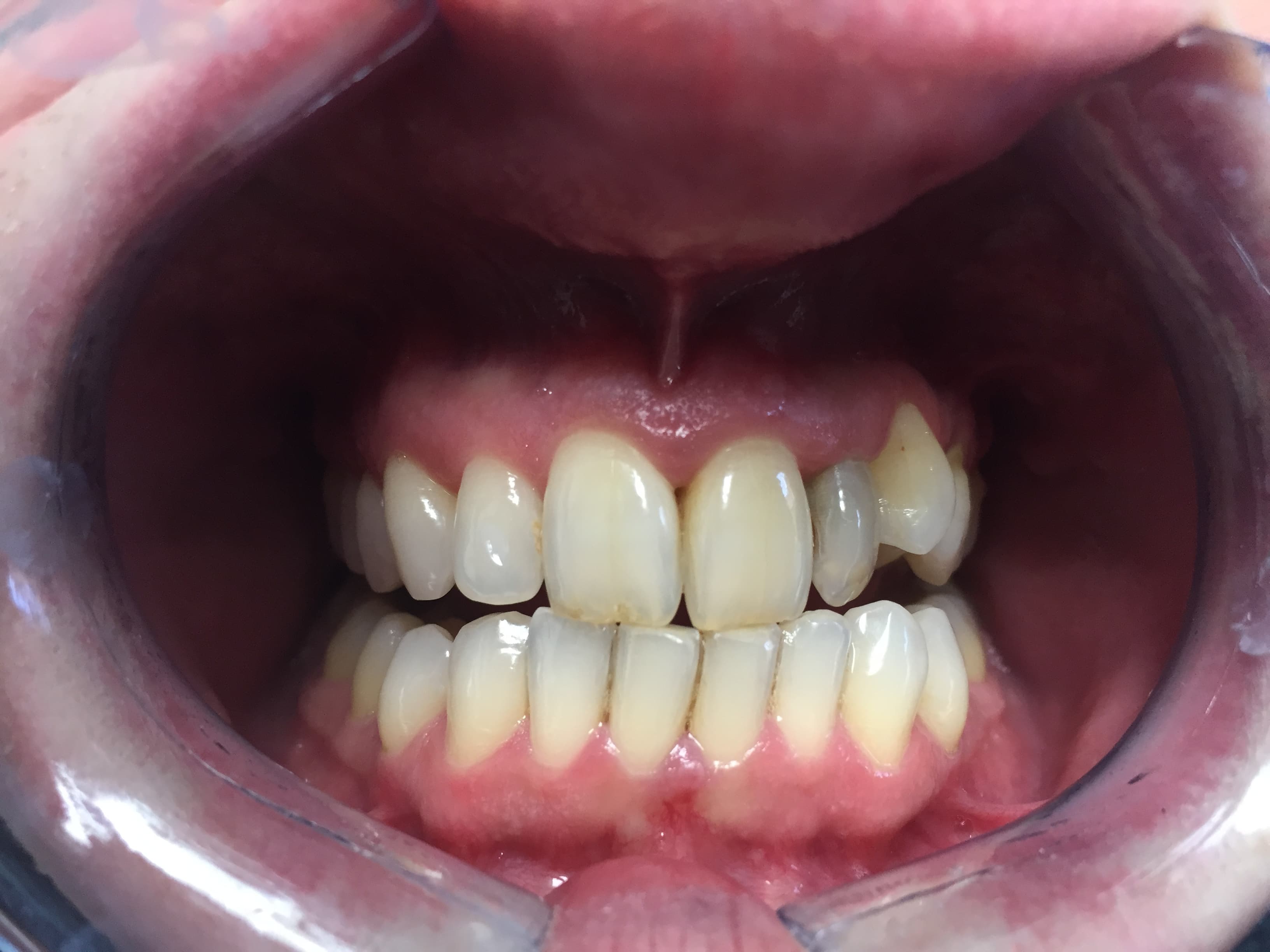 Professional teeth whitening — before treatment