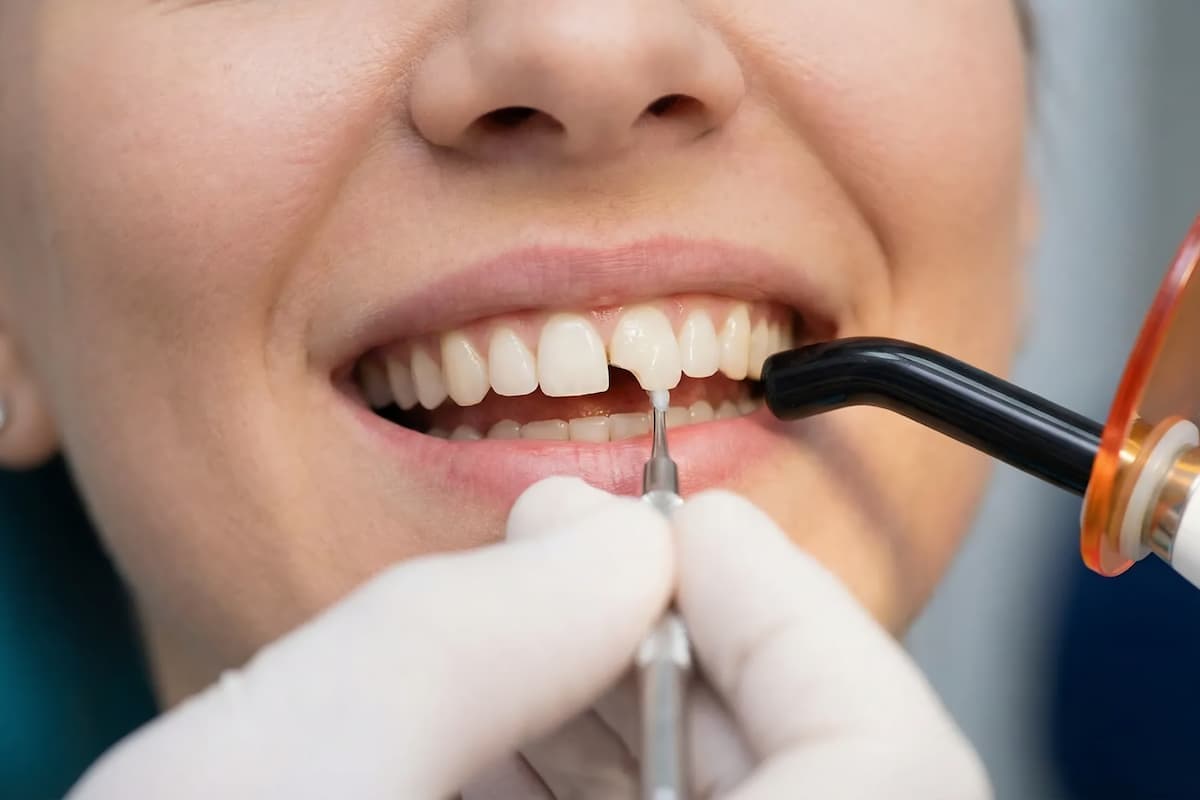 Concerns About Silver Fillings: Understanding Composite Restoration Options