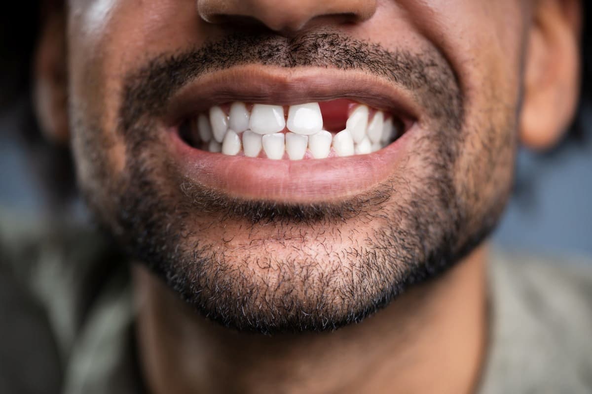Can a Missing Tooth Affect Your Oral and General Health?